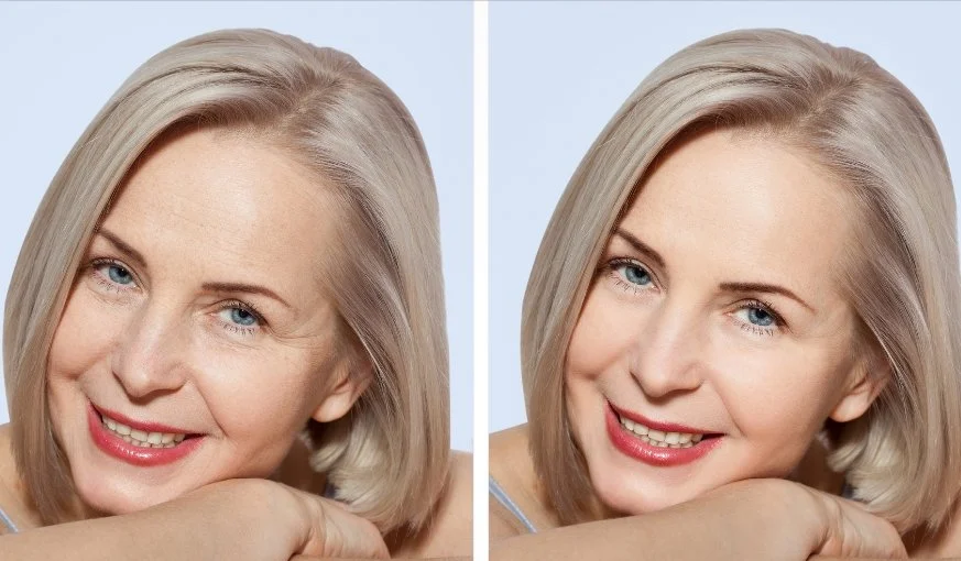 Facelift Surgery in Thailand – Packages and Prices