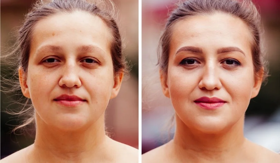 Deep Plane Facelift Cost, Benefits, Before And After