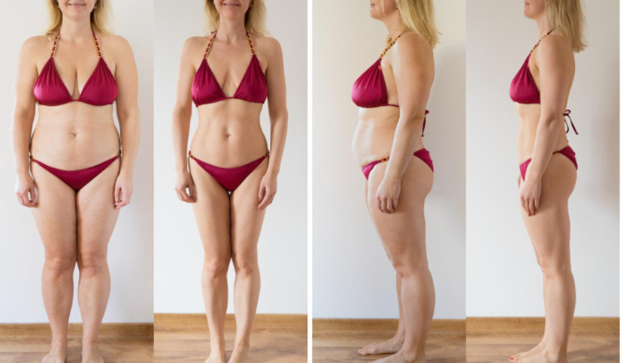 Upper Body Lift Surgery | Bangkok, Thailand