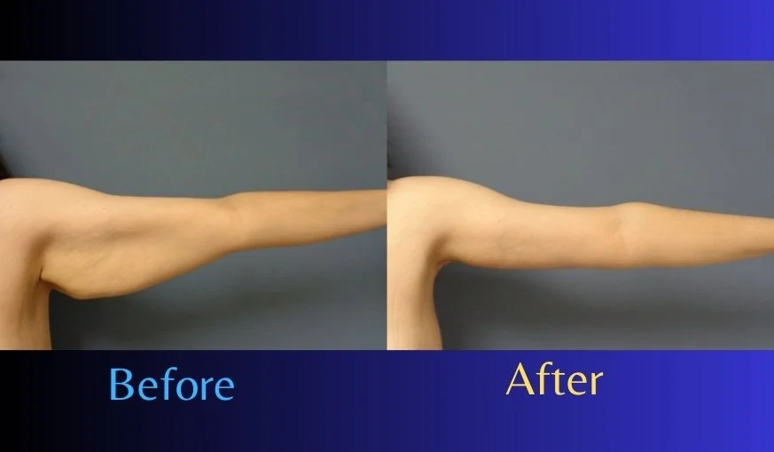 Arm Lift Before And After - Surgery Result With Photos