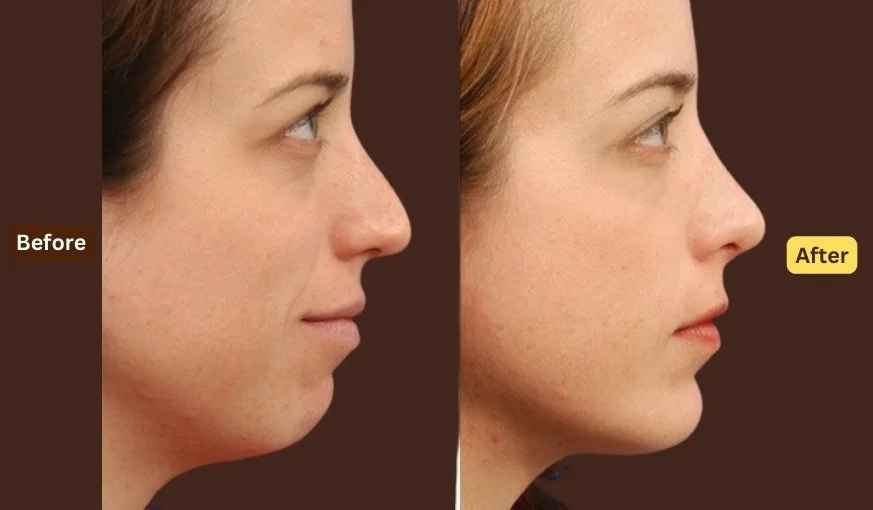 Chin Implant Before And After | With Case Study