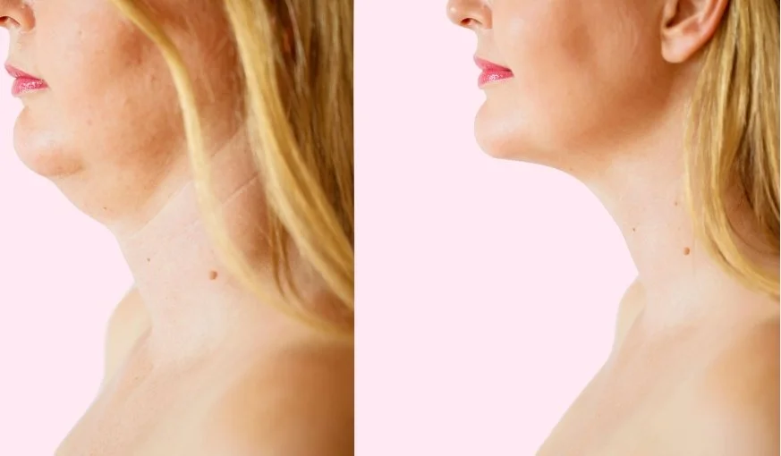 Necklift Cost, Benefits And Recovery Process