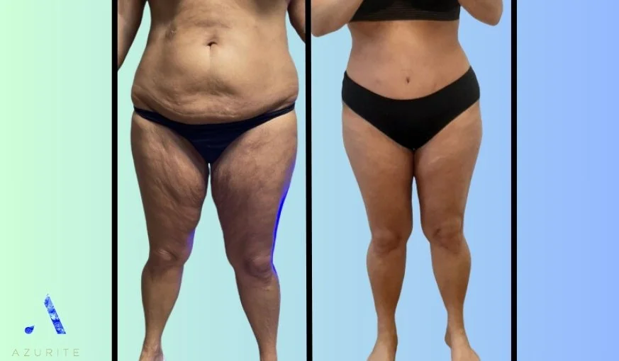 7 Secret Thing About Belt Lipectomy