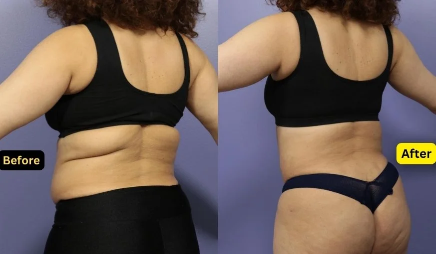 Bra-Line Back Lift Surgery Before And After