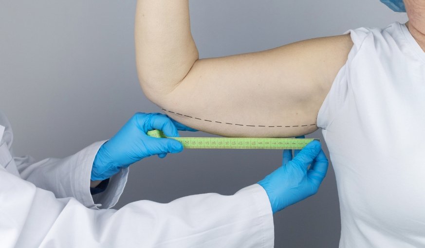 16 Benefits of Arm Lift (Brachioplasty) Surgery