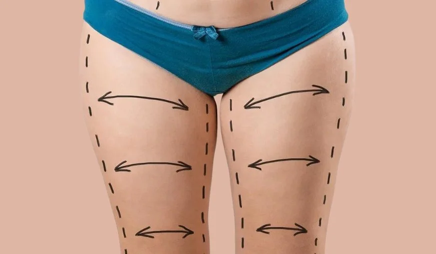 15 Benefits Of Thigh Lift Surgery