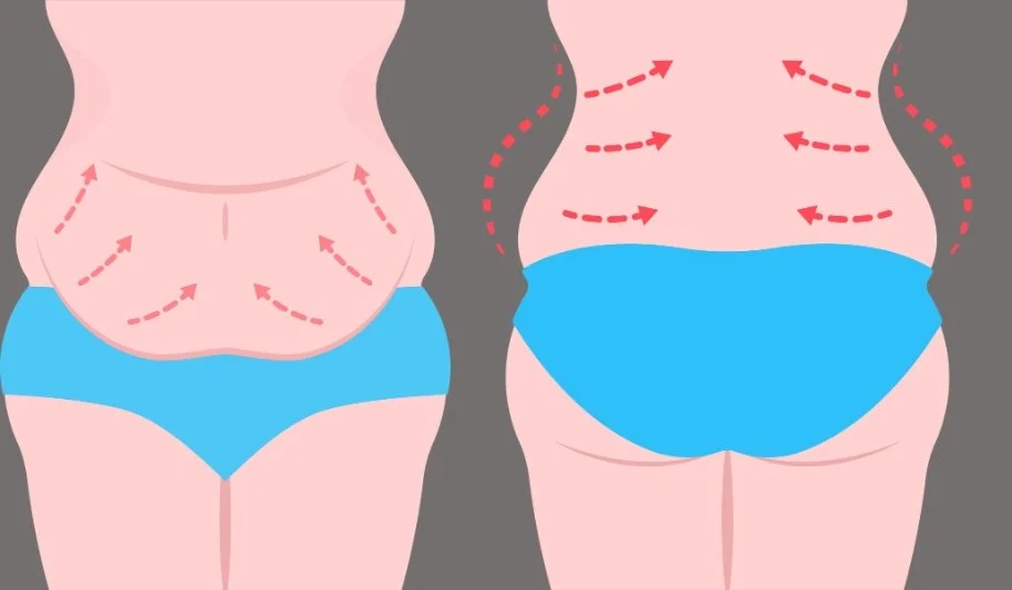 Concept of Muscle Etching Belt Lipectomy