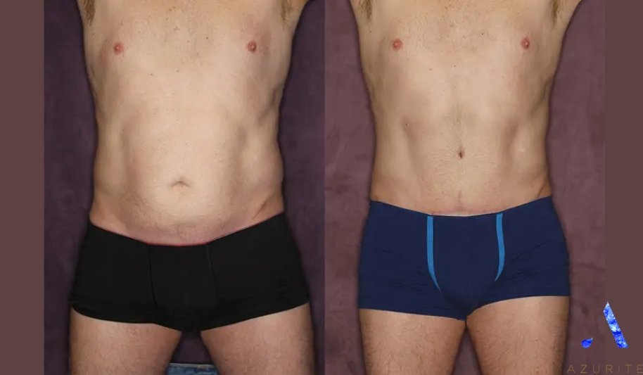 Tummy Tuck Before And After For Men