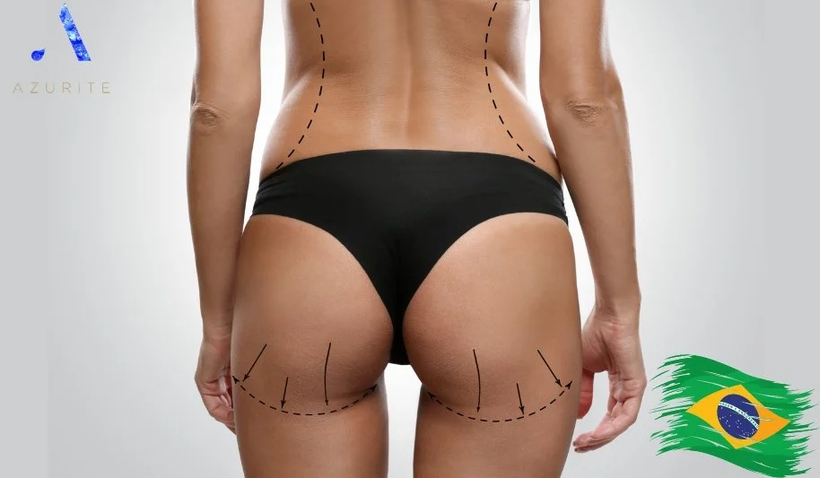 What Does A Brazilian Butt Lift Look Like