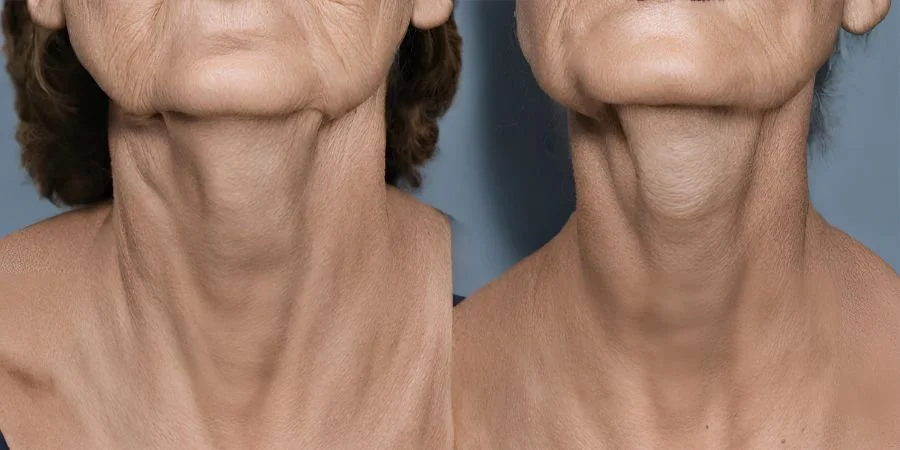 Revitalize Your Appearance With A Neck Lift In Bangkok, Thailand