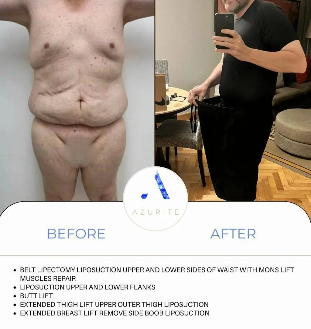 Post weight-loss surgery, body contouring before and after transformation showing comprehensive skin removal and body lift results. Individual results not guaranteed.