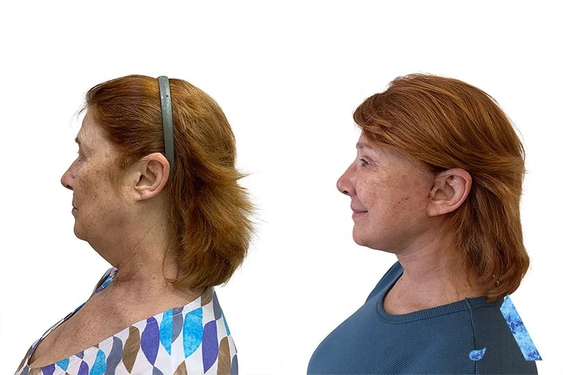 Side-by-side profile comparison of a woman before and after a cosmetic procedure, showing noticeable changes in her neck and jawline on a white background.