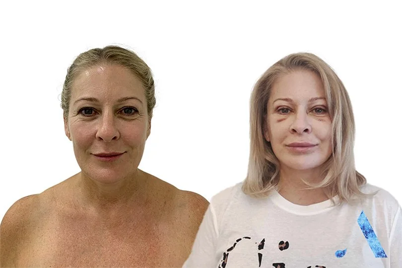 Before and after photos of a woman following a cosmetic procedure, showing changes in skin and appearance.