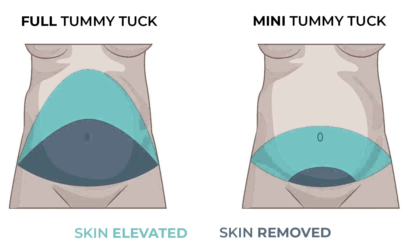 Rendered image Mini vs Full Tummy Tuck Diagram