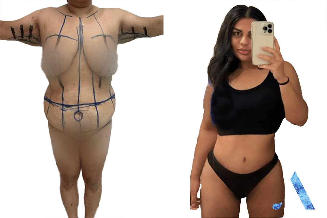 Thailand - Belt Lipectomy - Before and After