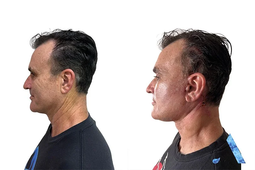 Side by side comparison of a man's profile before and after a facial procedure on a white background.