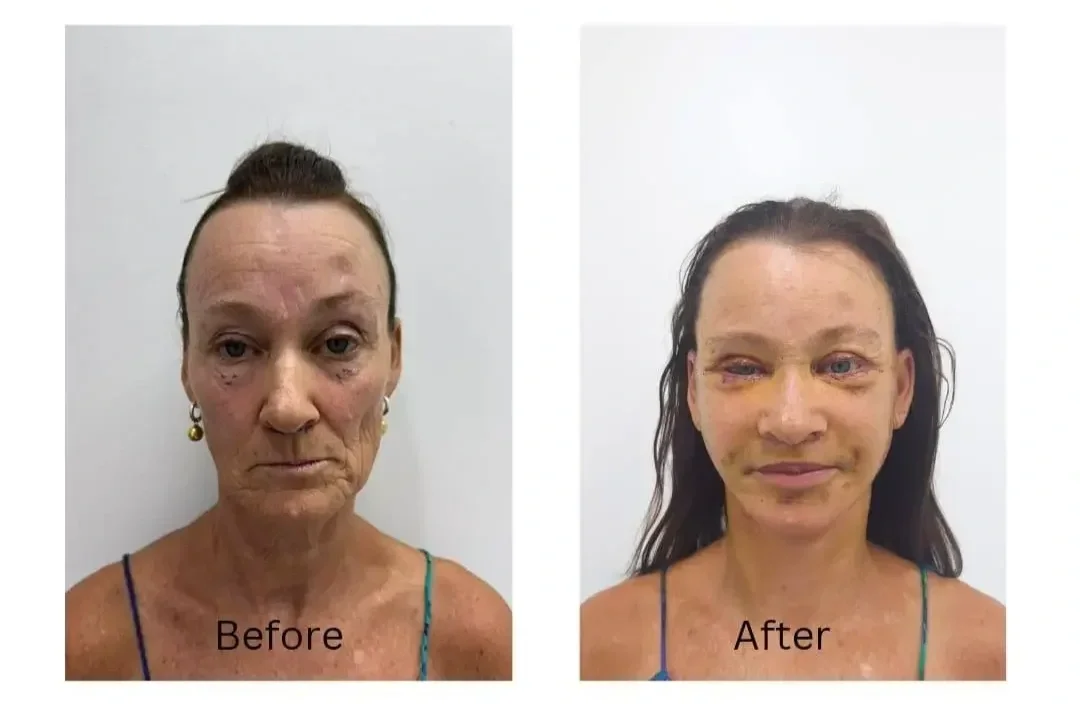 Full facelift vertical restore