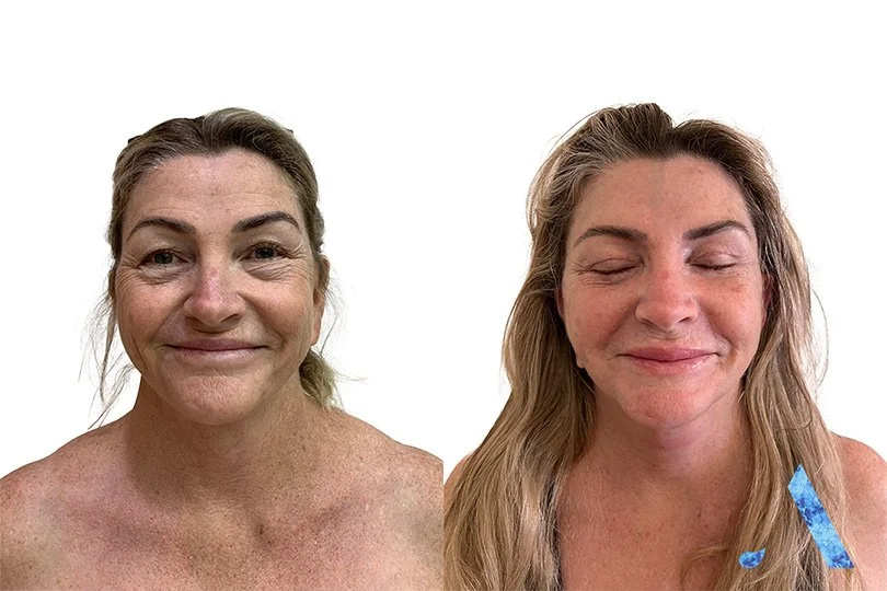 Side-by-side comparison of a woman's face showing differences possibly due to cosmetic treatment.