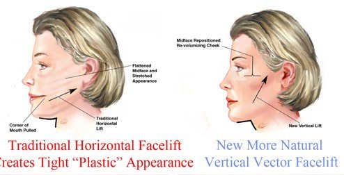 vertical restore facelift