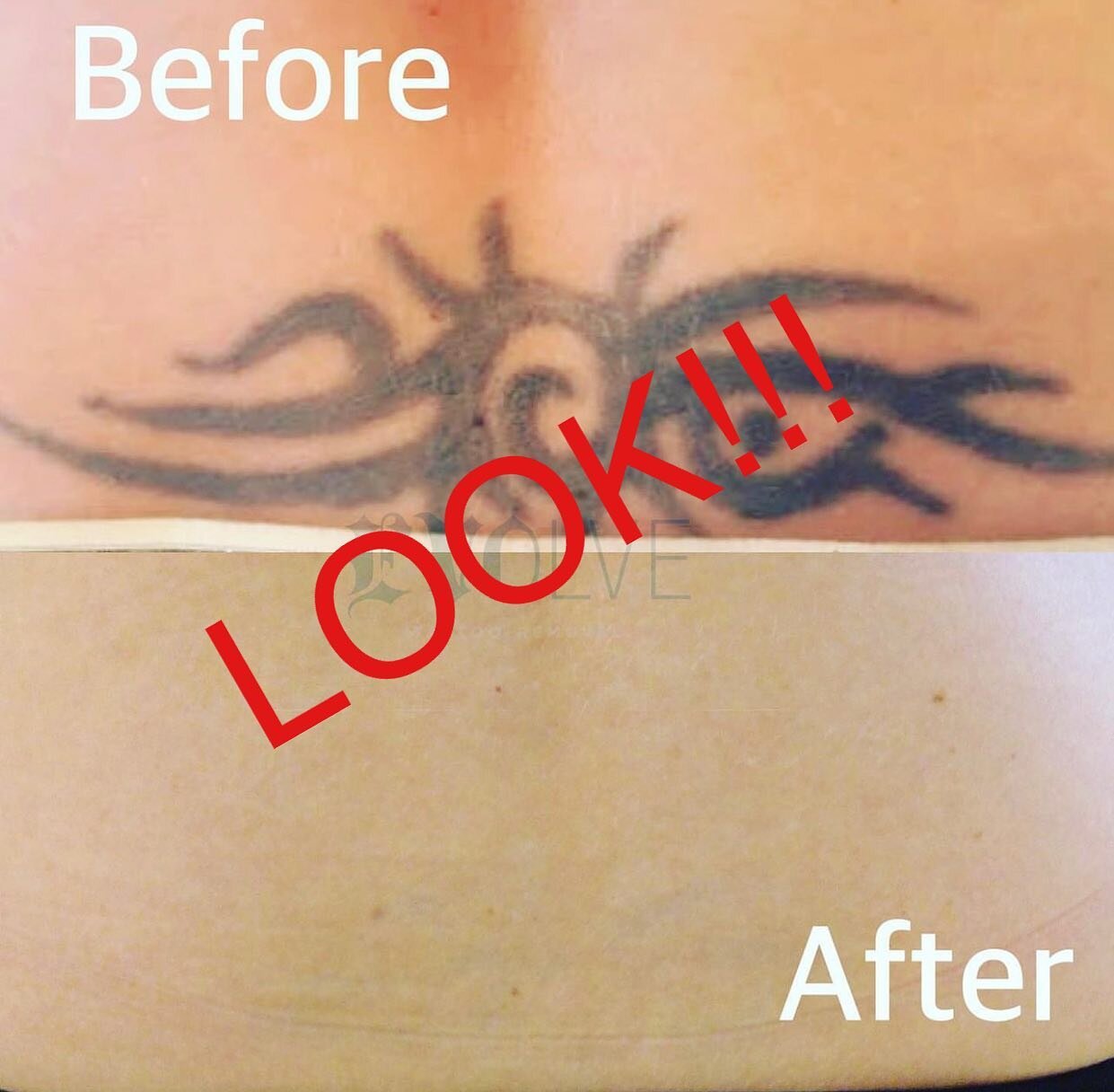 San Diego Laser Tattoo Removal Clinic   REALISTIC PROGRESS PICTURES  5 treatments SO FAR Treatments starting Only 79 Tattoo Removal Guarantee  Free Consultations Quanta Discovery Pico Laser Technology 11 years  Experience