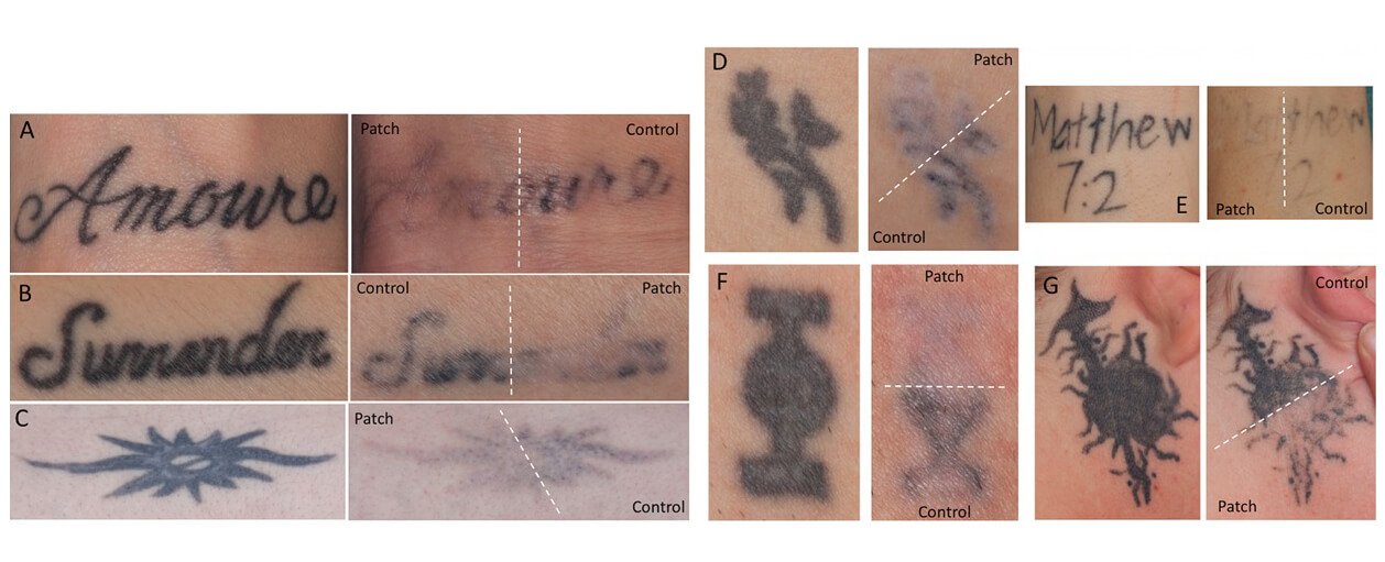 Before and After (current) w/ Picosure Pro! About 20 months with 7 sessions  total. Used the Describe PFD patch for 2 sessions! : r/TattooRemoval