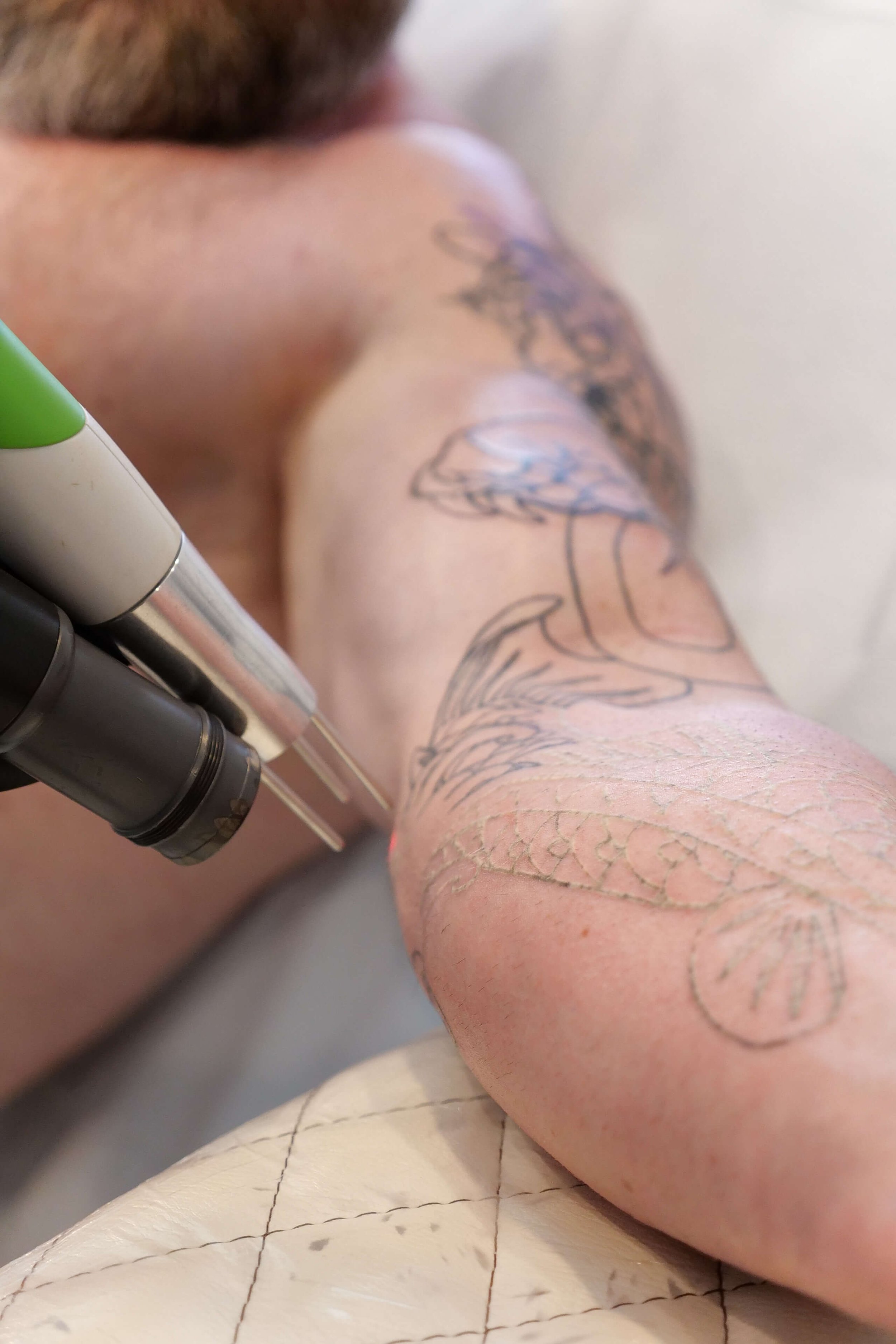 Does laser tattoo removal hurt? - Vanishing Ink