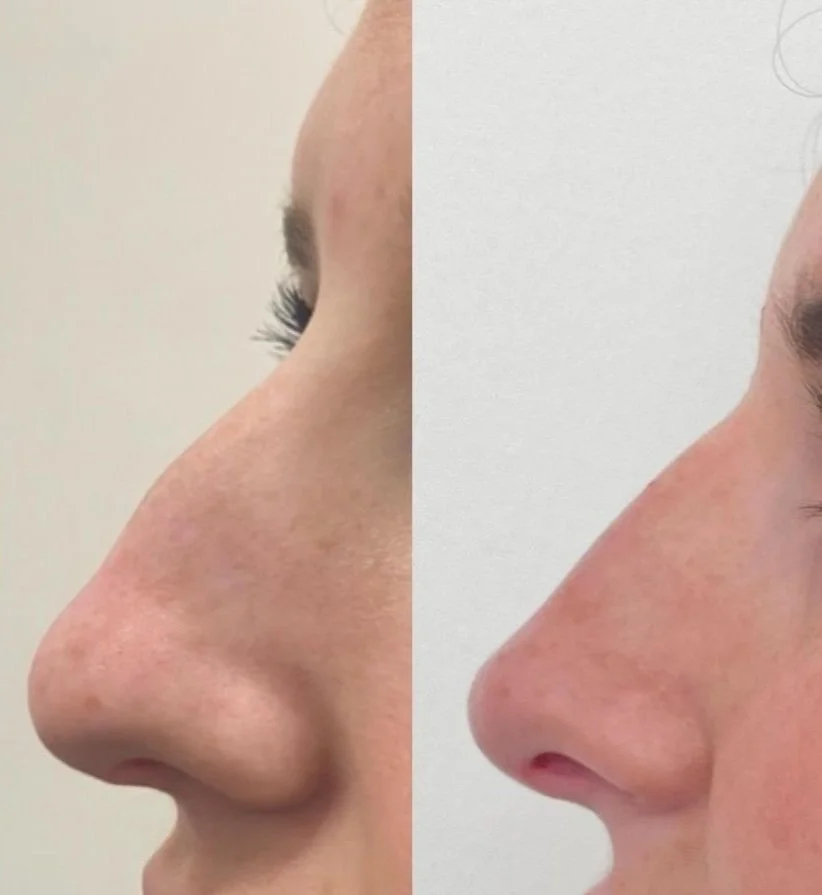 Before and after of non surgical rhinoplasty treatment by Courtney Cassidy