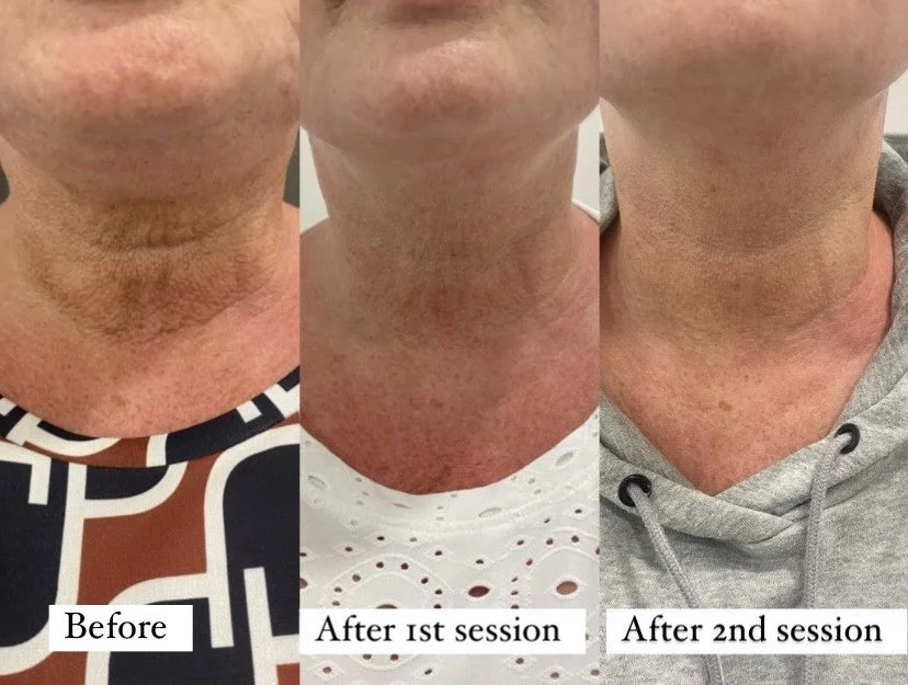 CCA - FRACTIONAL RADIOFREQUENCY SKIN RESURFACING.jpg