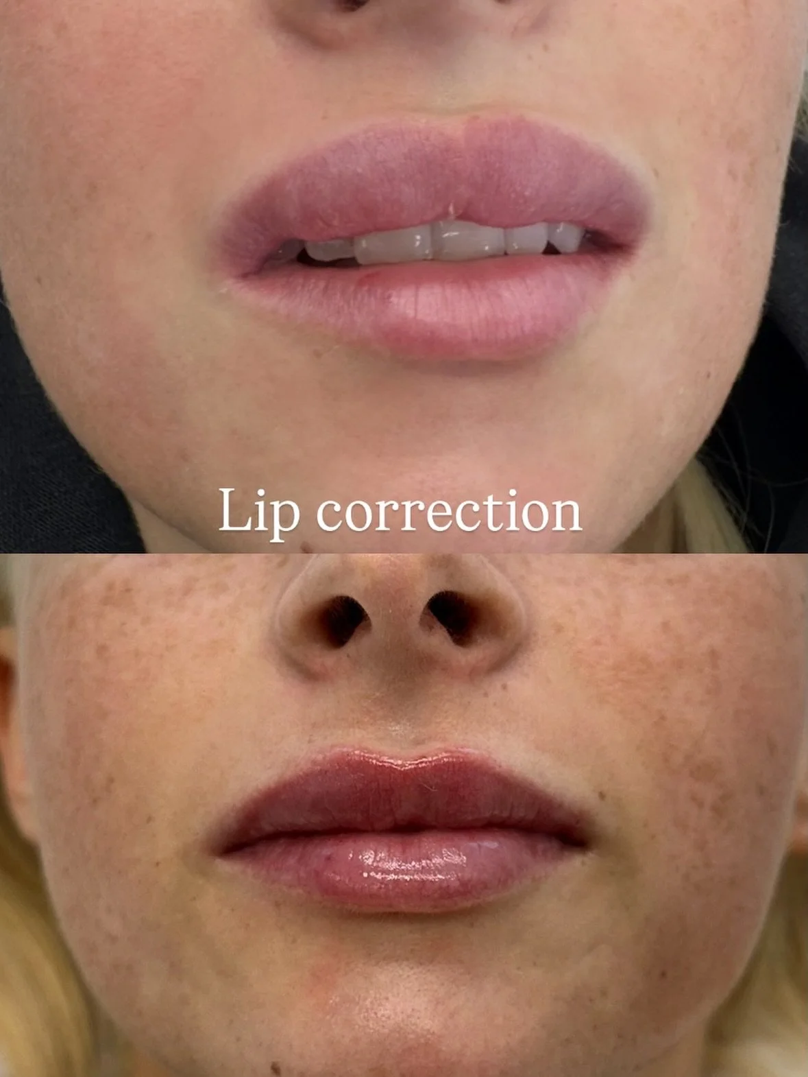 LIP CORRECTION-  Correction work carried out by dissolving lumpy / migrated dermal filler. The lips have now been defined, refreshed, and back in balance. Subtle always wins. I am so happy I can give the confidence back to this lovely lady. ❤️