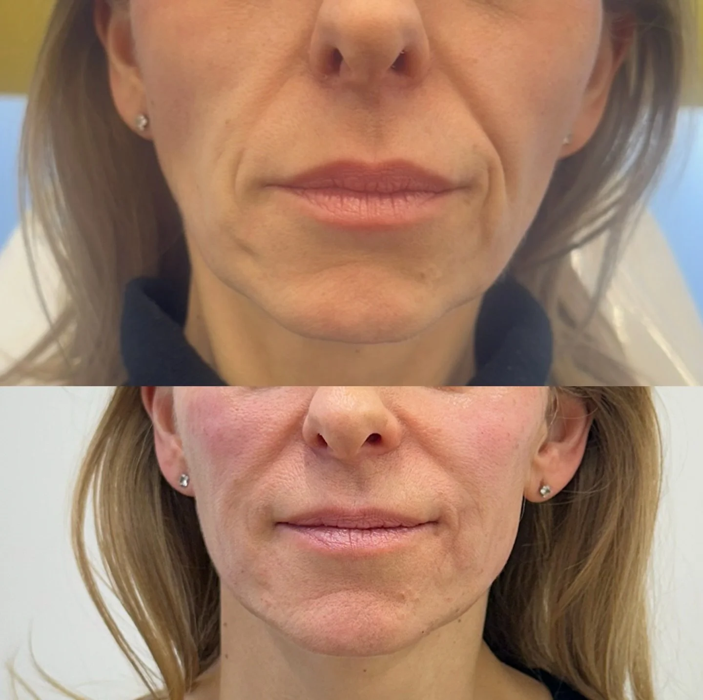 Strategic tweaks over time allowed timeless results, this lovely lady now feels more rejuvenated and confident.

We set out a tailored treatment plan to restore volume and support in the face.. Trust the timeline. Trust the process. 🤎