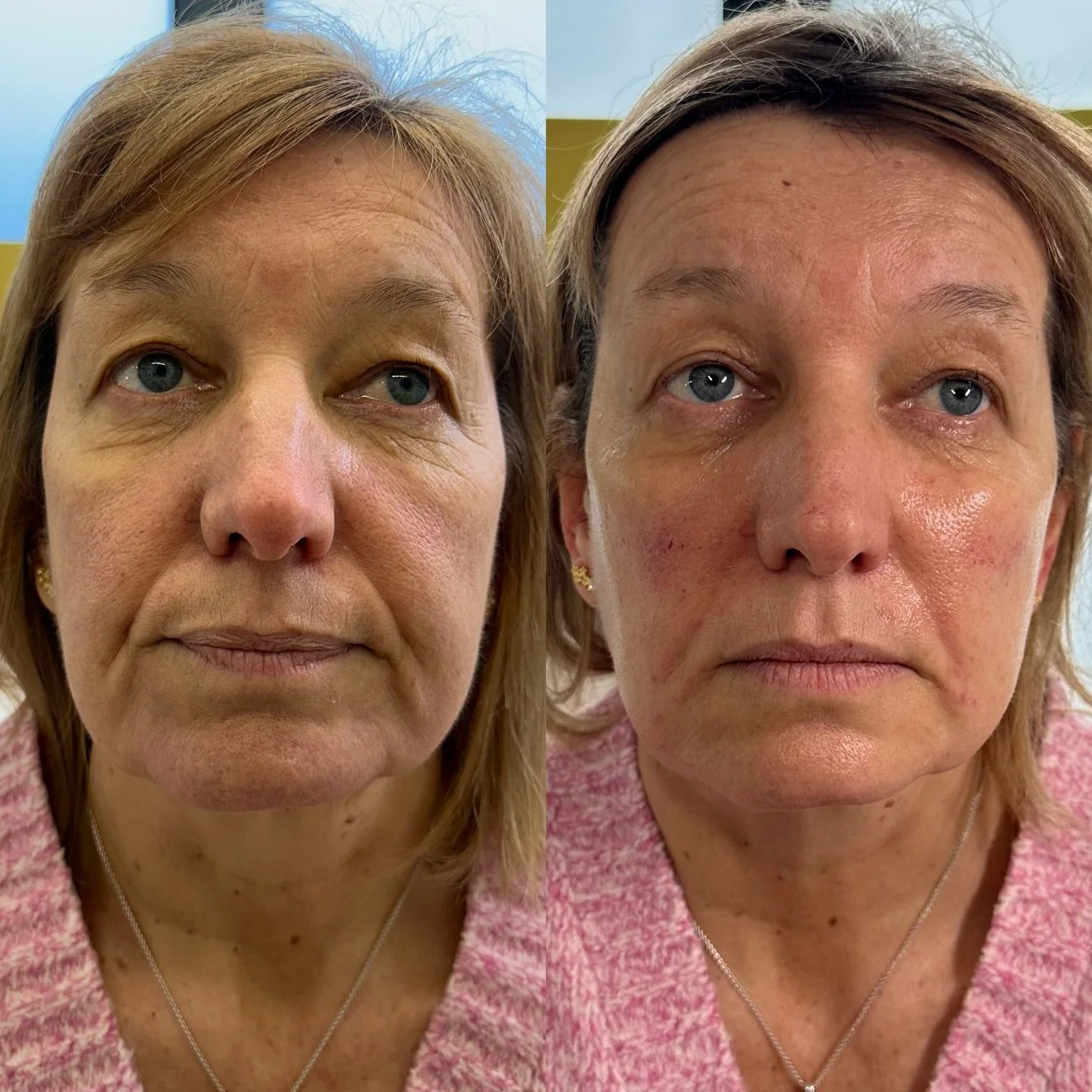 ✨ Full Face Approach = Natural, Balanced Results ✨

Dermal filler isn&rsquo;t just about treating one line or one area &mdash; it&rsquo;s about understanding the whole face. During consultation, we assess facial structure, proportions, and areas of v