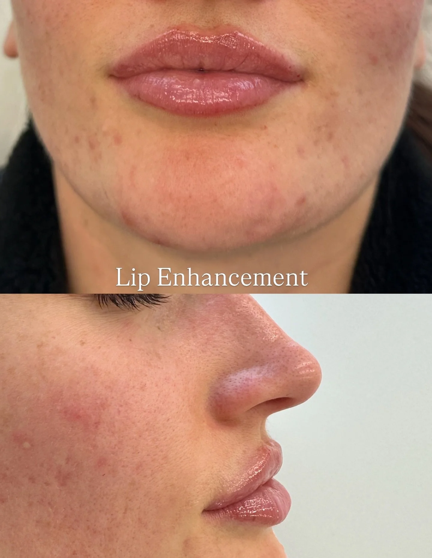 Lip filler isn&rsquo;t just about bigger lips&mdash;it&rsquo;s about enhancing what&rsquo;s already there 💋

This treatment can:
&bull; Refine shape &amp; symmetry
&bull; Define the lip border
&bull; Deeply hydrate &amp; smooth
&bull; Add soft, natu
