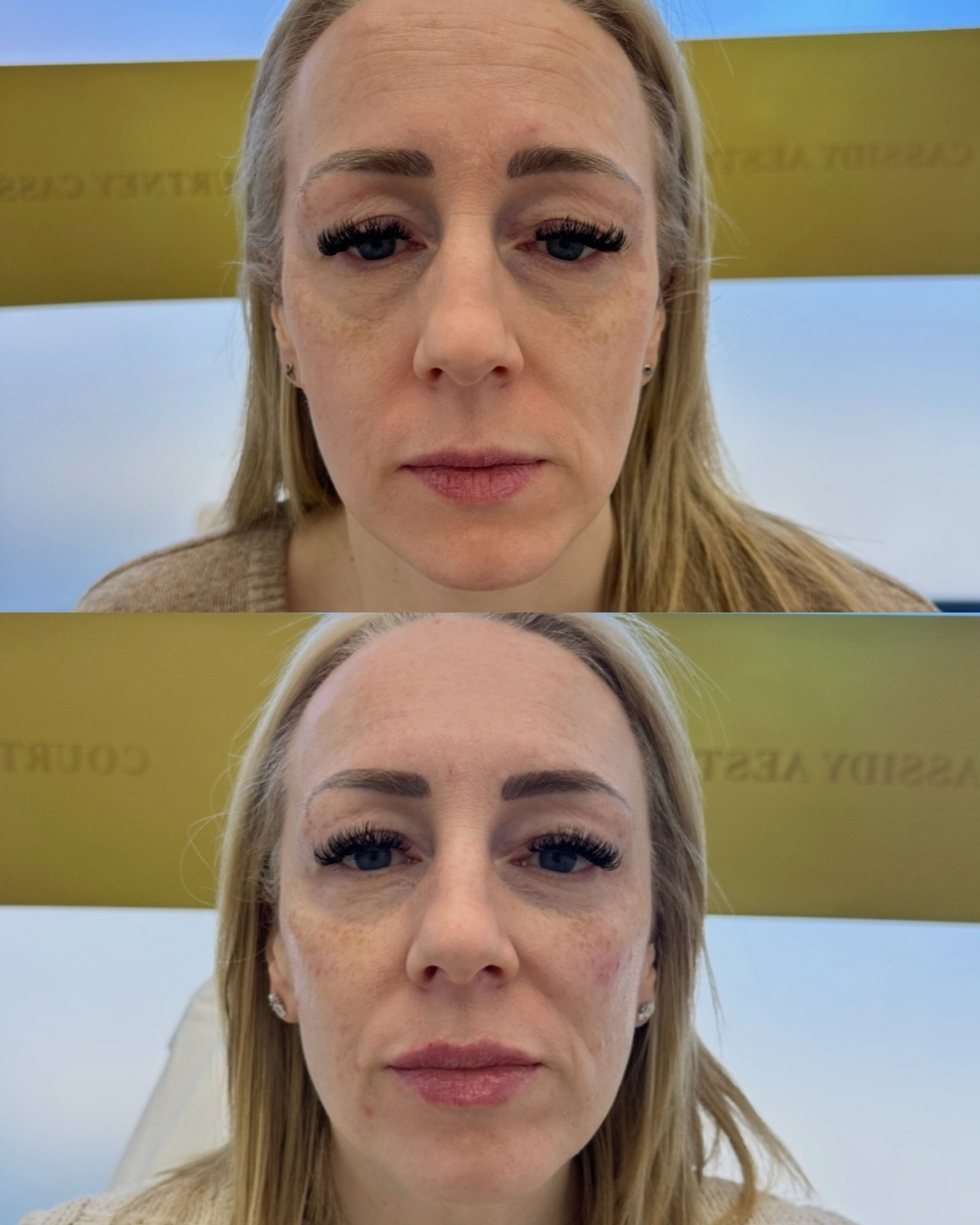 Thislovely lady came in for a consultation feeling that her face looked tired and wanting to improve her overall skin quality ✨

Our treatment plan focused on restoring subtle volume through the cheek and mid-face area to create a fresher, more suppo