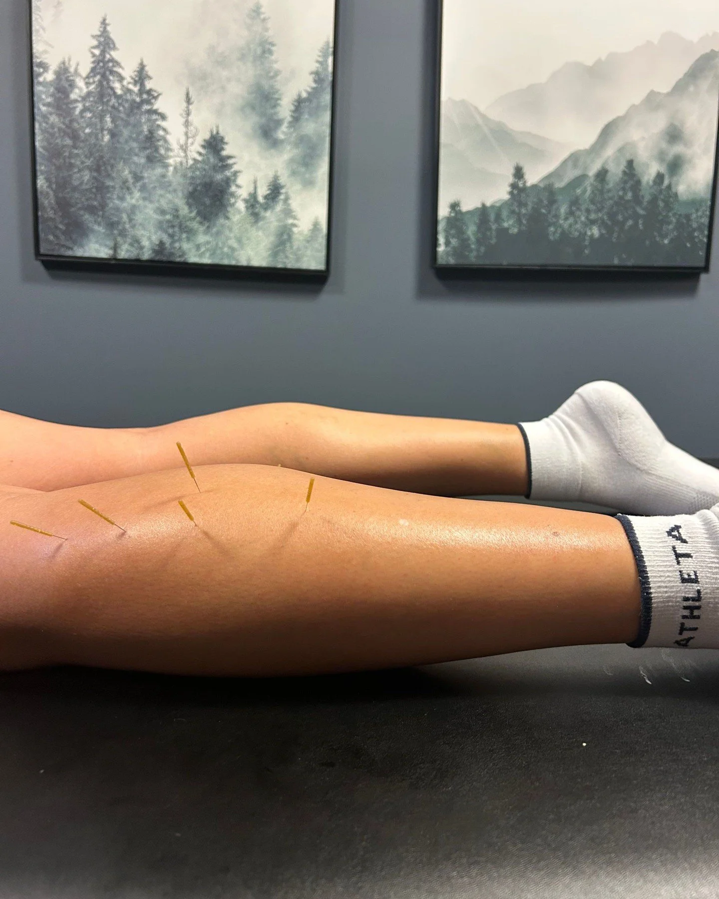 A few tiny needles can make a big difference. Dry needling helps calm tight muscles, relieve pain, and get you moving better again 🙌