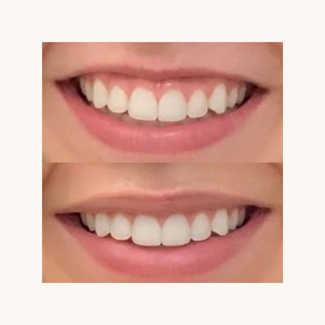 Lip Flip with Botox