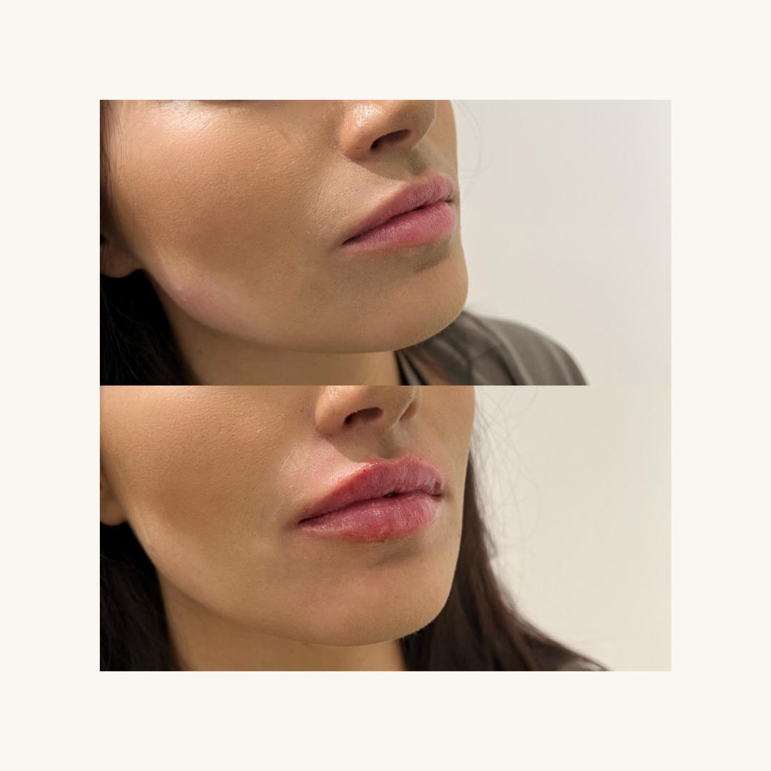 Juvederm Ultra