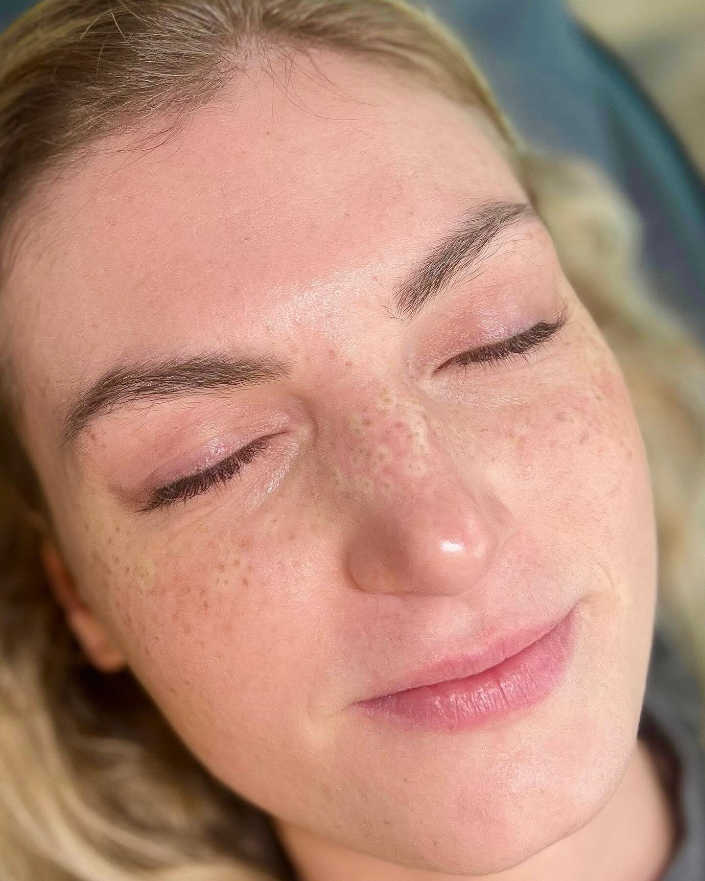 Fresh freckles looking so cute✨They fit her face so well!

The numbing cream that was used during her procedure causes the white ring you see around some of the freckles. This is not permanent and wears off in ~1 hour.

📍 Sumner, WA
Service - Medium