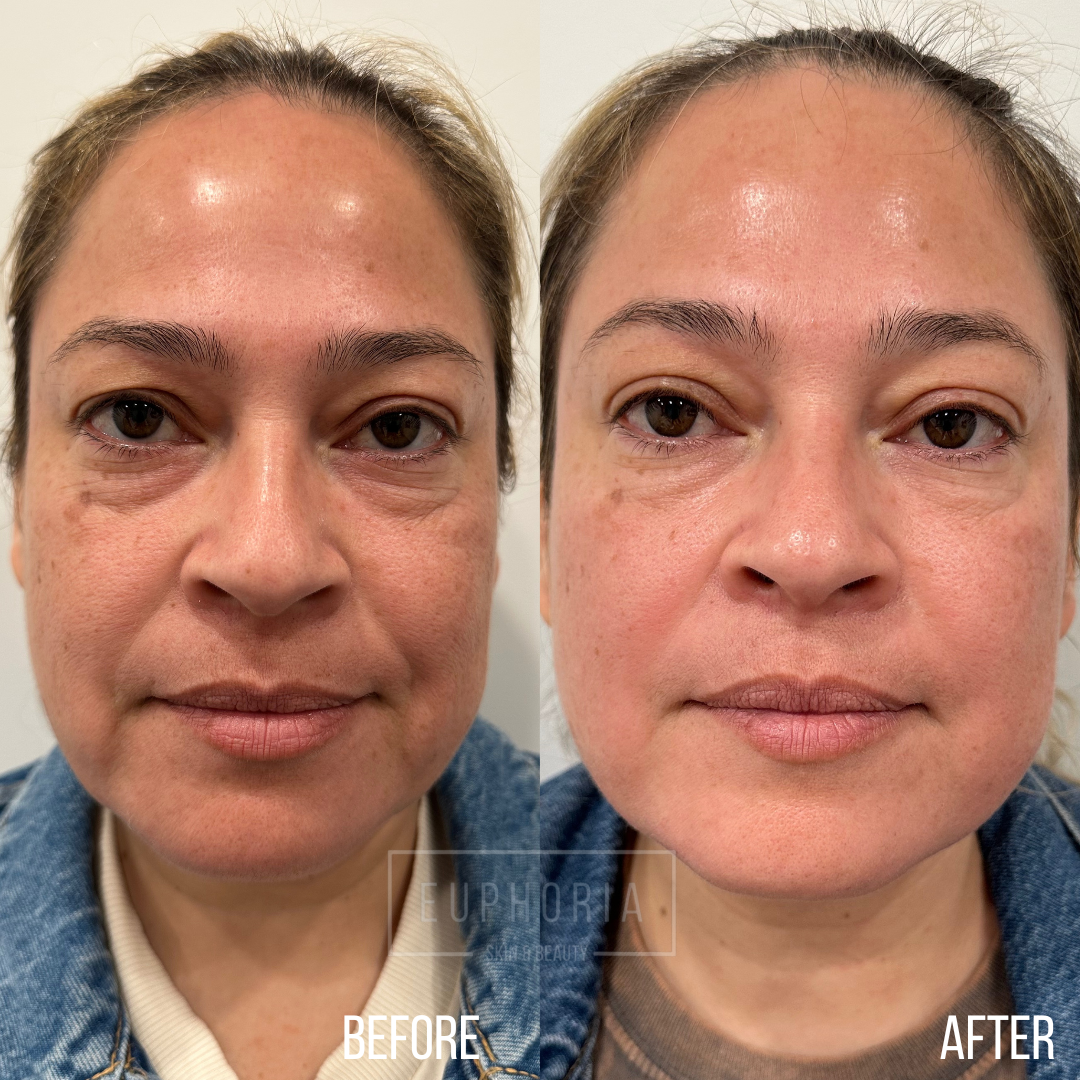 before and after of prp microneedling