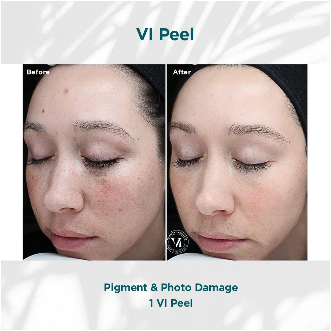 VI-Peel-Before-and-After-Encino-CA-3-1.jpg