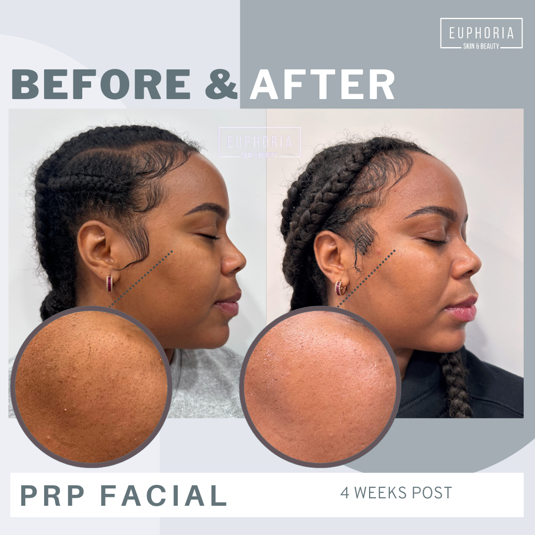 before and after prp microneedling