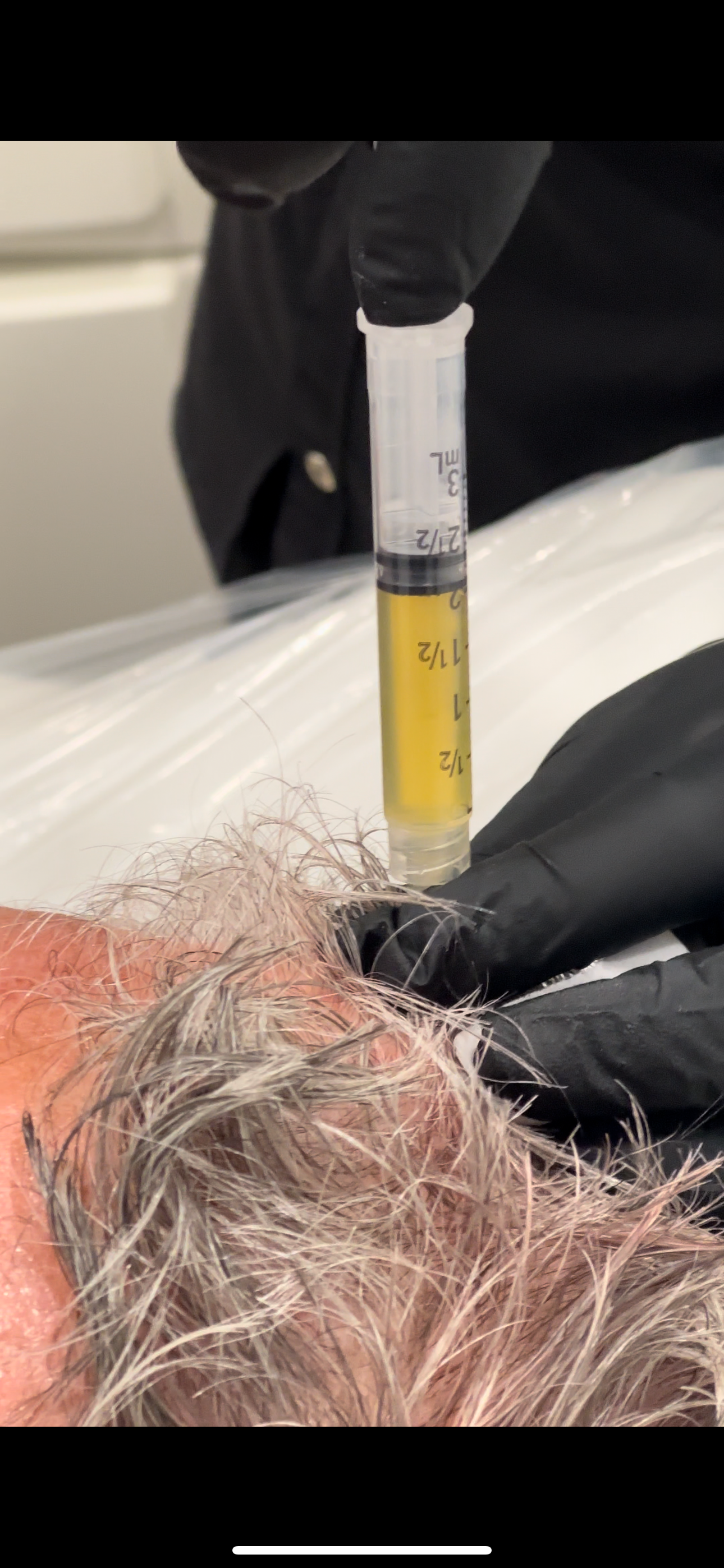 PRP Hair Loss Treatment