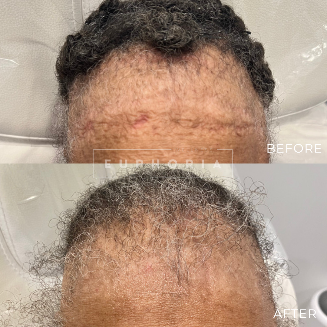 2 MONTH FOLLOW UP RESULTS WILL CONTINUE TO IMPROVE