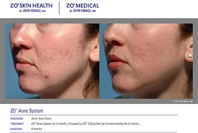 ZO-before-and-After-3-step-peel.jpg