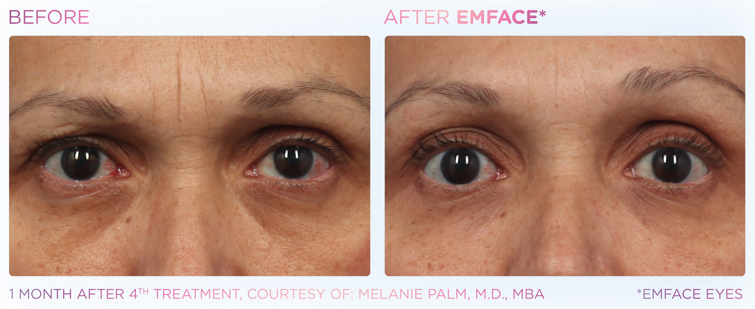 Emface_PIC_Ba-card-female-eyes-172_ENUS100.png