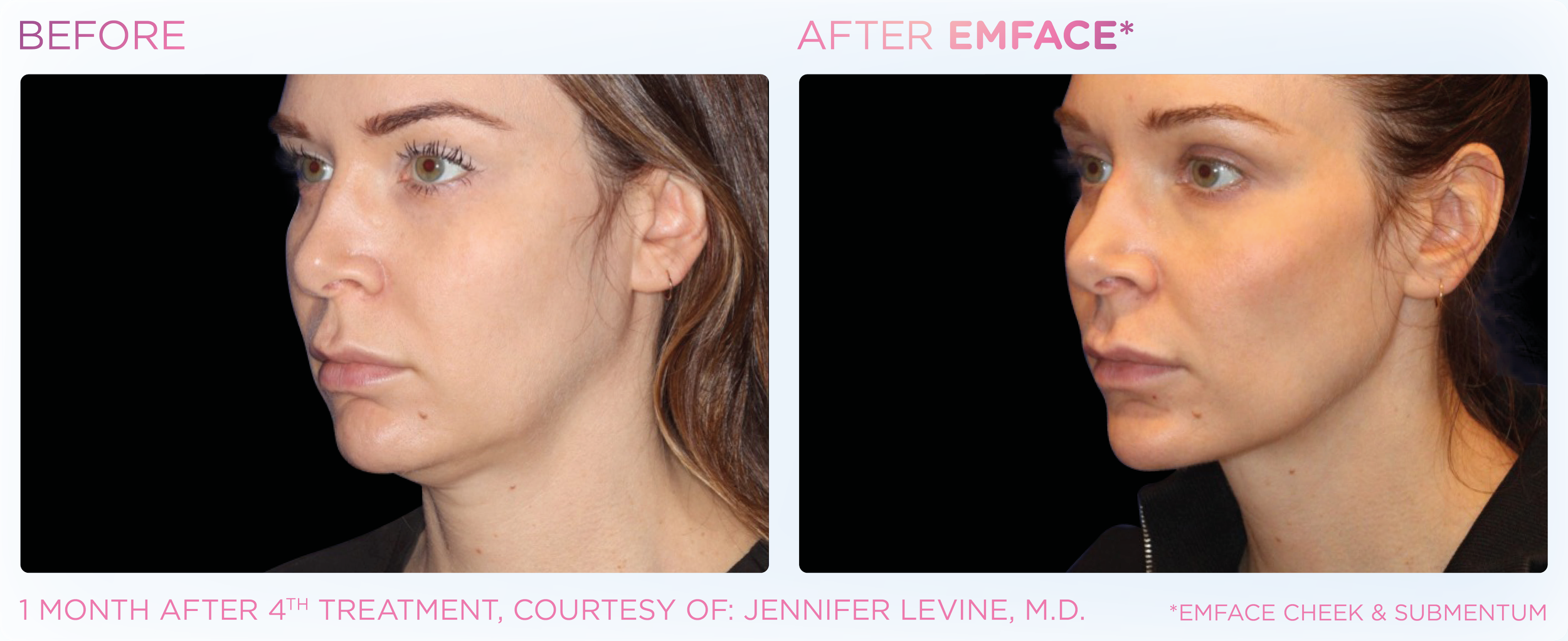 Emface_PIC_Ba-card-female-submentum-cheek-124_ENUS100.png