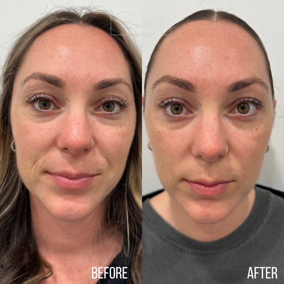 before and after prp microneedling