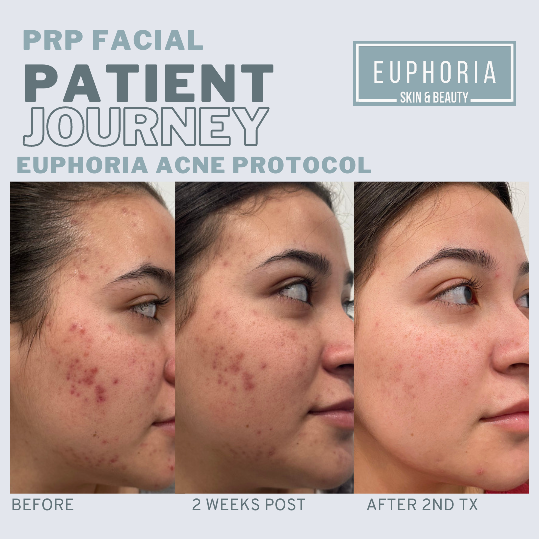 prp microneedling for acne scars