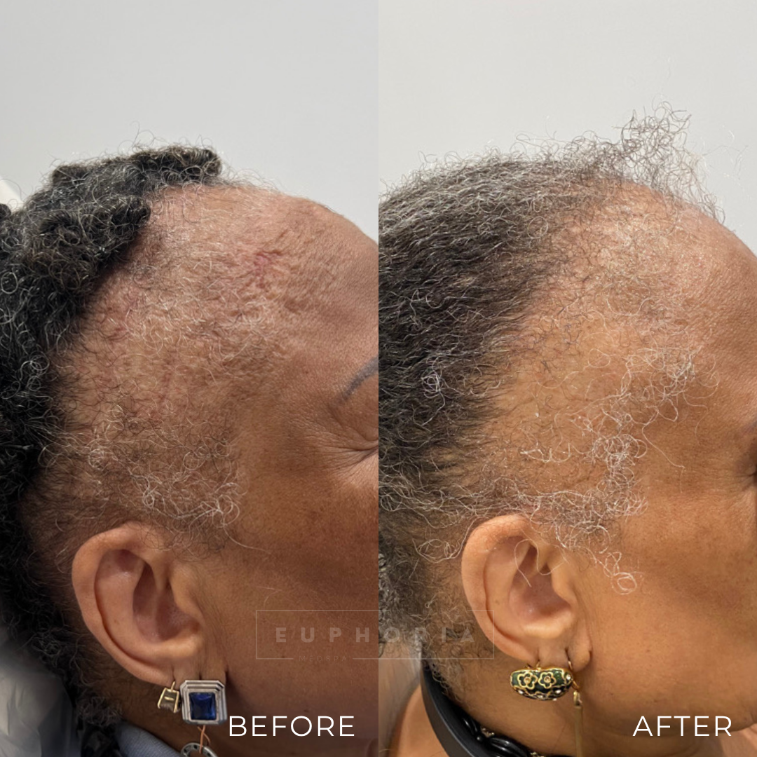 2 MONTH FOLLOW UP RESULTS WILL CONTINUE TO IMPROVE