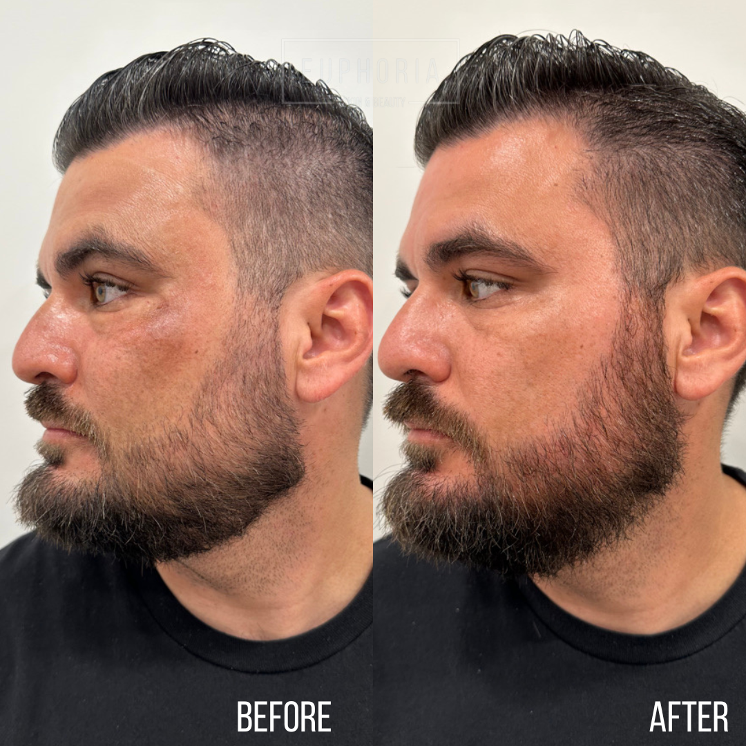 before and after prp microneedling for melasma