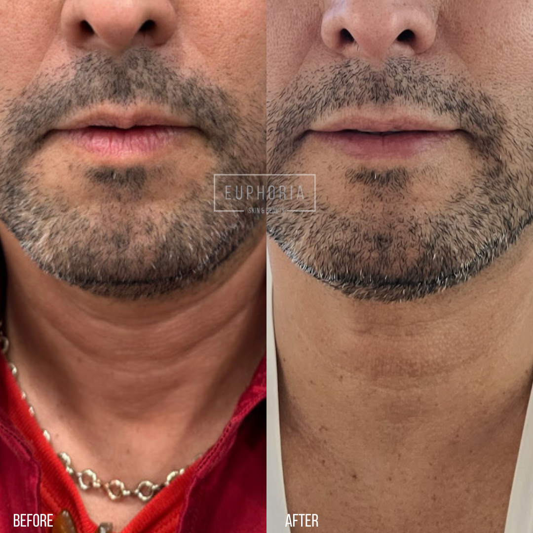 before and after of prp microneedling on neck